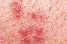 Shingles facts, suggestions and information about Shingles prevention, treatment and symptom relief